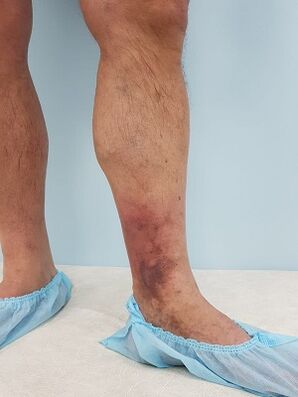 complicazioni da vene varicose negli uomini