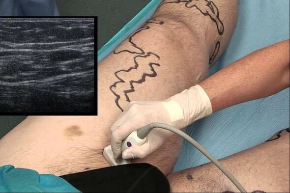 diagnosi delle vene varicose negli uomini