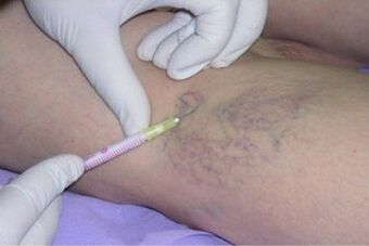 scleroterapia come metodo di trattamento delle vene varicose
