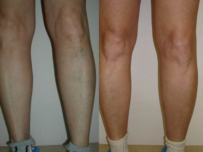 gambe prima e dopo il trattamento laser delle vene varicose