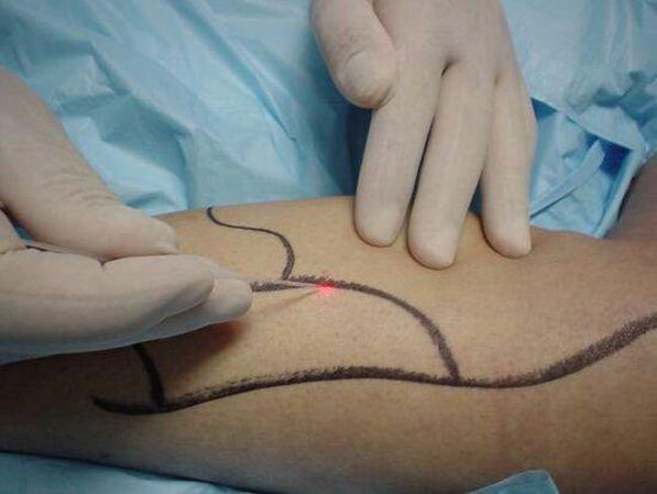 trattamento laser delle vene varicose