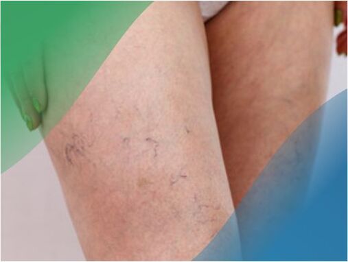 La rete vascolare sulle gambe è uno dei sintomi delle vene varicose