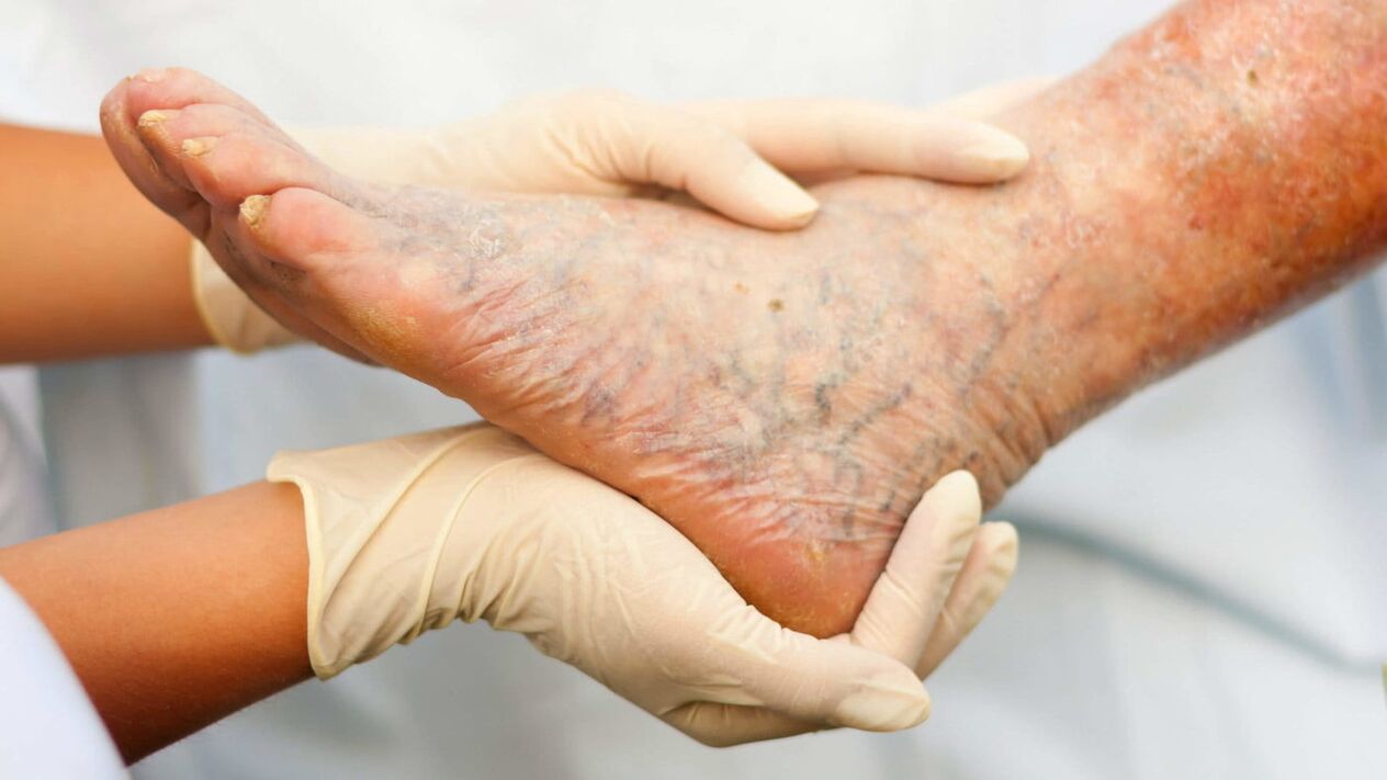 Il flebologo si occupa del trattamento delle vene varicose alle gambe