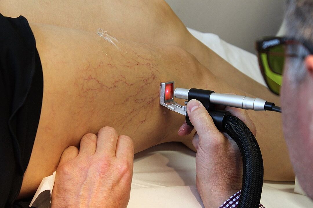 Coagulazione laser