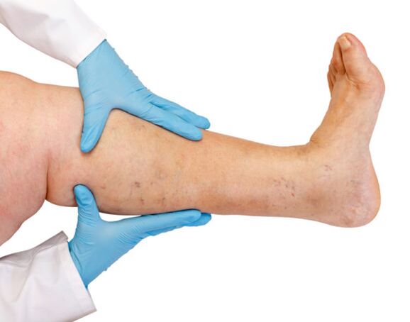 Vene varicose sulle gambe
