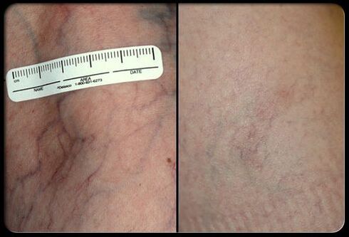 Prima e dopo la procedura di terapia laser
