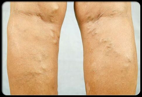 Vene varicose sulle gambe